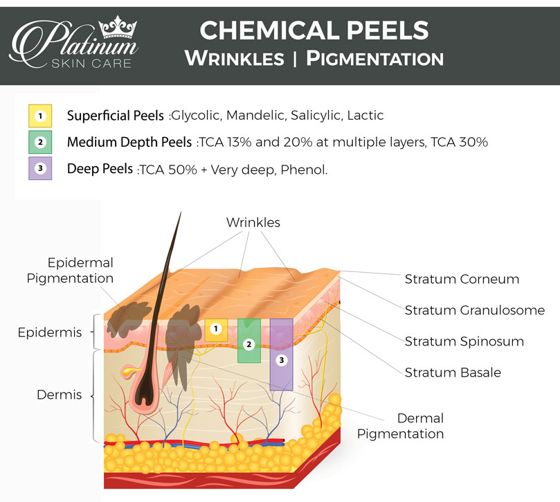 https://peeluniversity.com/wp-content/uploads/2021/05/chemical-peels-and-skin-layers-depth-small.jpg