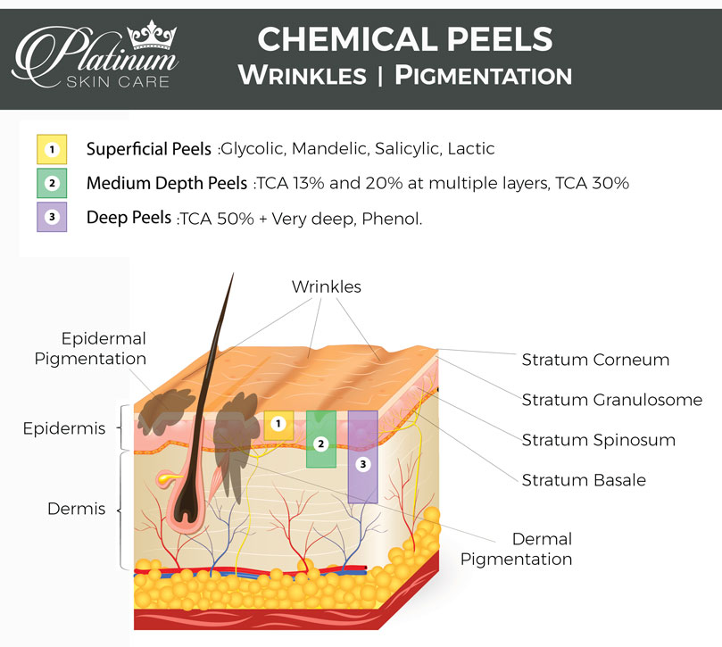 What is the Difference Between a Light, Medium, and Deep Chemical Peel?